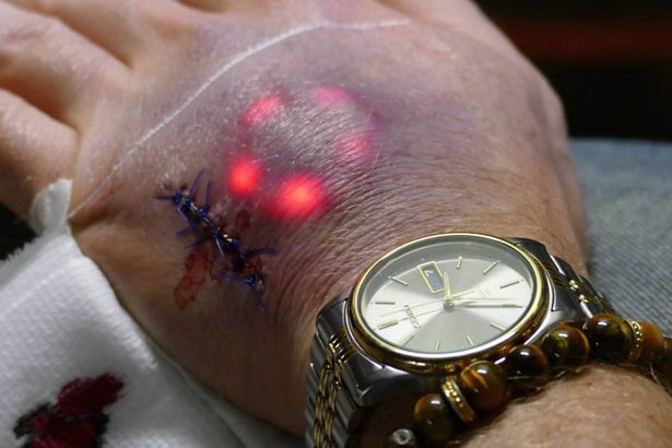 Biohack-Implant